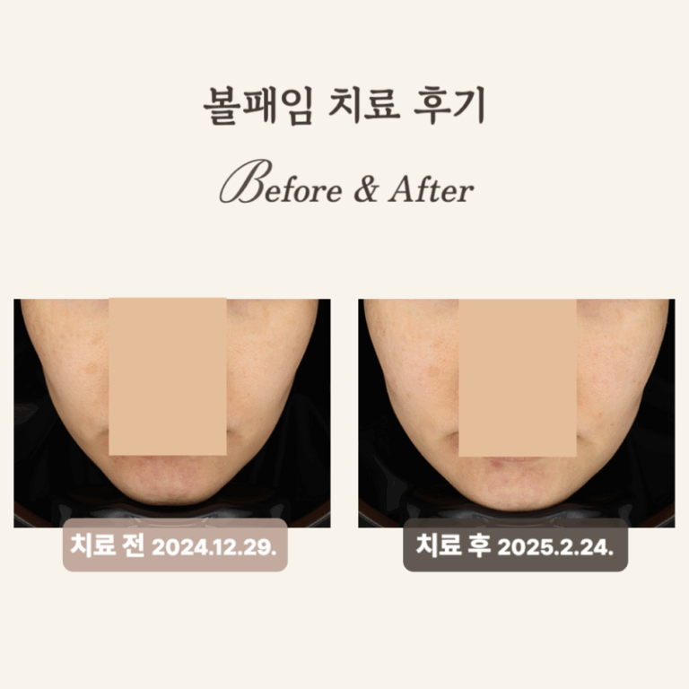 40대 울트라콜·쥬베룩 후 젊어진 얼굴 후기