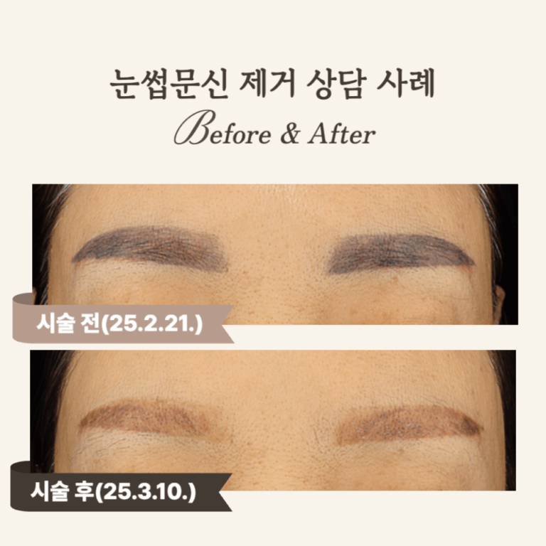 50대 눈썹문신 피코토닝 후 자연스러운 변화 후기