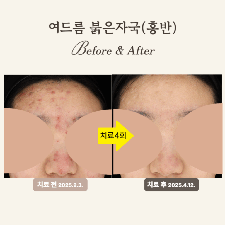 20대 이마·코 홍반, 브이빔 레이저 4회 치료 후기