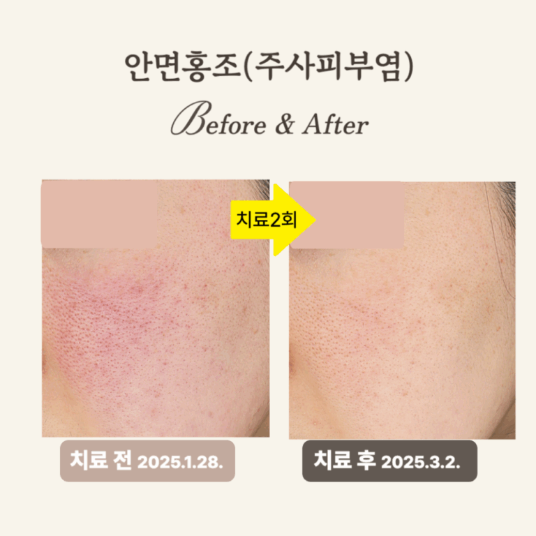 브이빔 레이저 30대 안면홍조 시술 후기: 효과적인 치료!