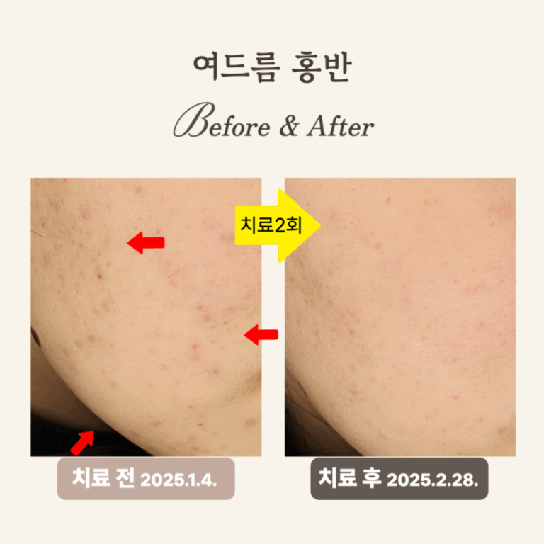 10대 여드름 붉은 자국, 브이빔 시술 후기