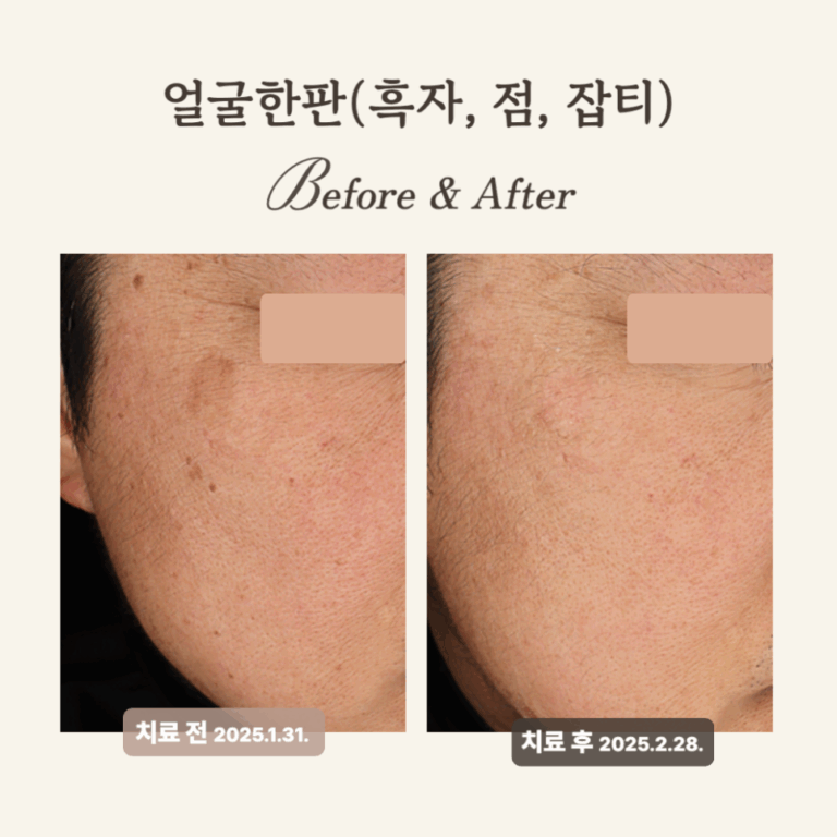 50대 눈가, 볼 흑자 레이저 치료 후기
