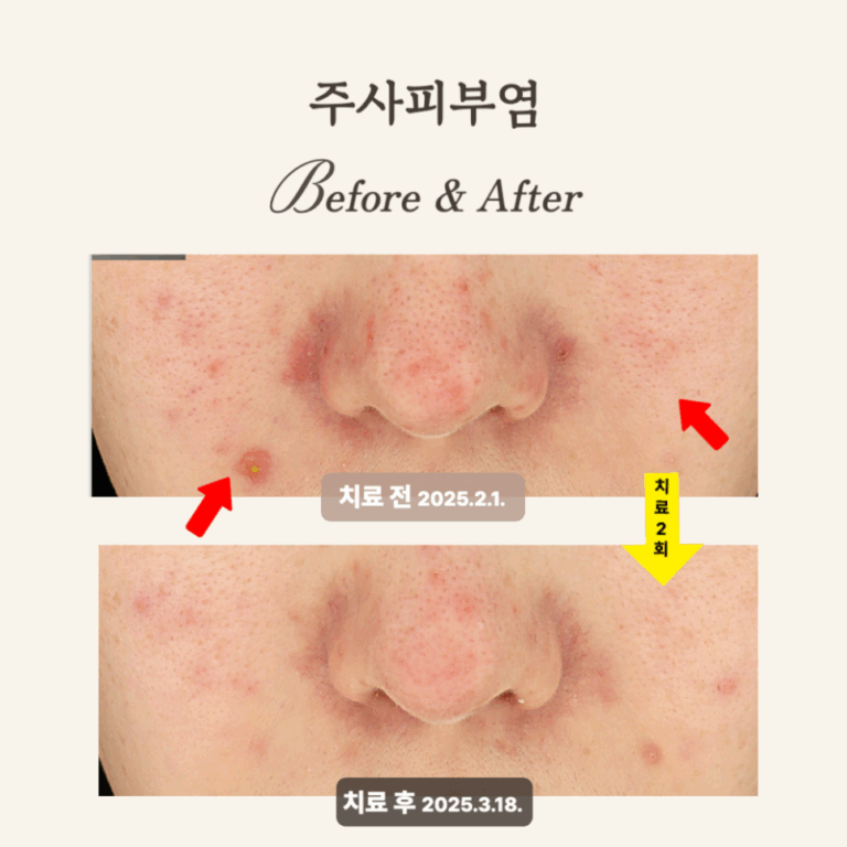 20대 민감성 피부, 브이빔 2회로 주사피부염 극복 후기