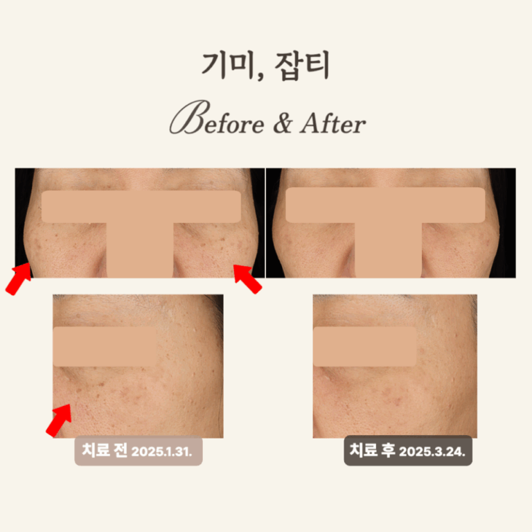 50대 잡티와 기미 치료 후기: 피코토닝과 레이저토닝