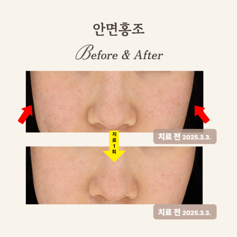 20대 민감성 피부, 브이빔 레이저 1회 시술 후기