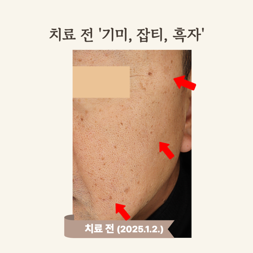 60대 진피형 기미, 레이저 토닝 후기