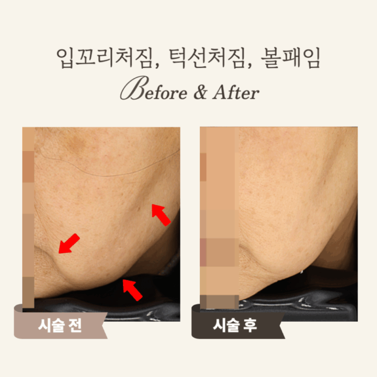 60대 울쎄라 시술 후기: 탄력있는 턱선으로 젊음 회복!