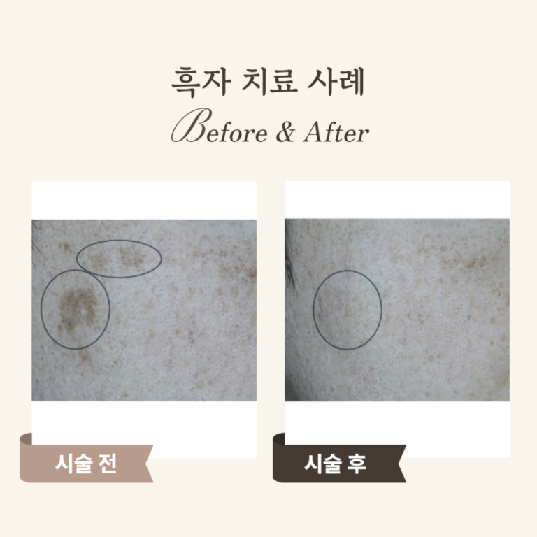 40대 기미·흑자 해결! 피코 레이저 치료 후기