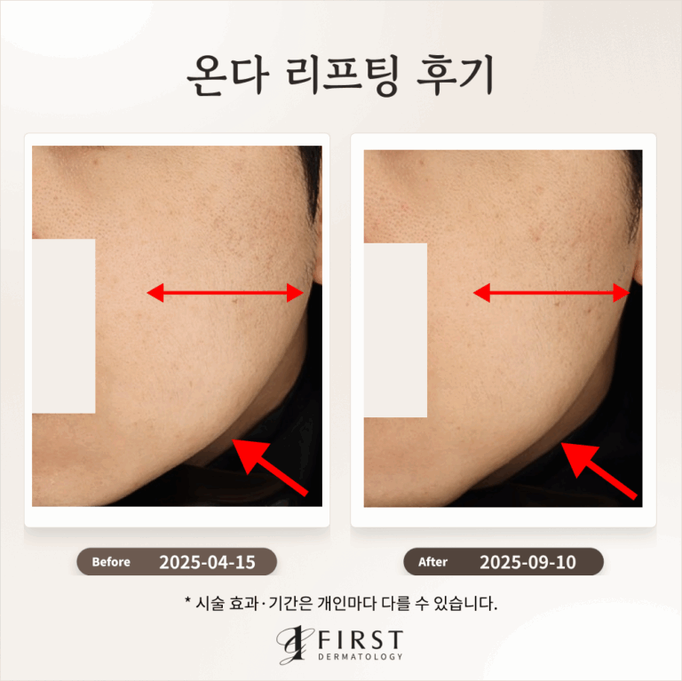 온다 얼굴 리프팅 후기_광교퍼스트피부과