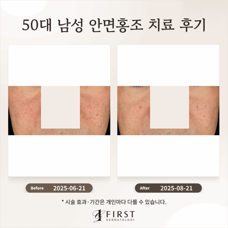 50대 남성 안면홍조 치료 후기_수원피부과 후기