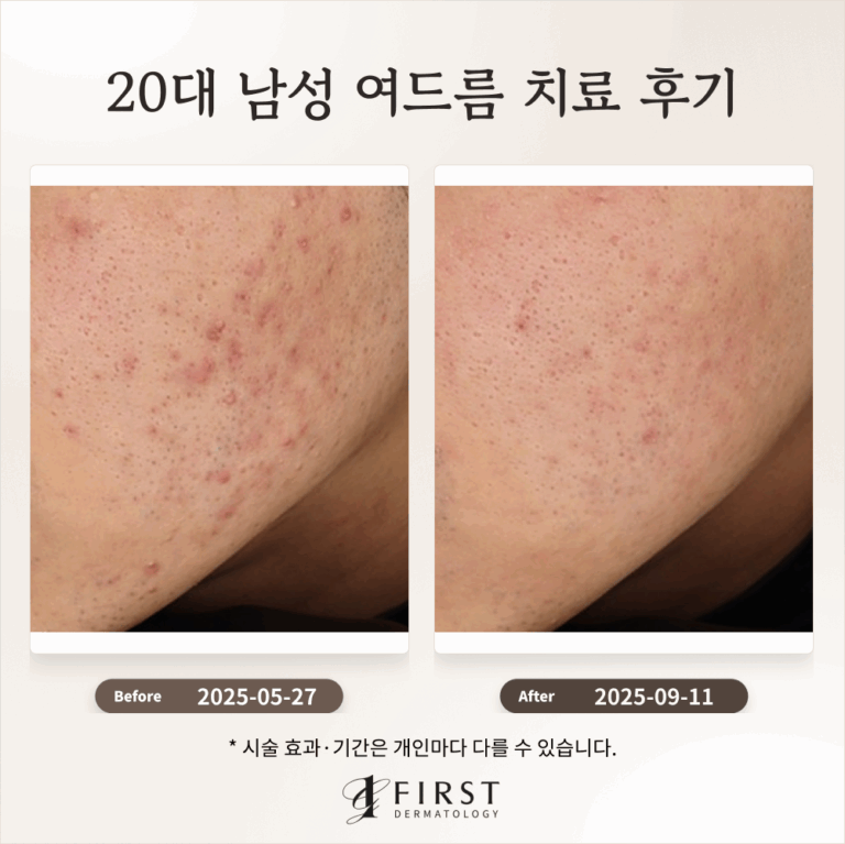 20대 남성 여드름 치료 후기_수지여드름피부과 후기