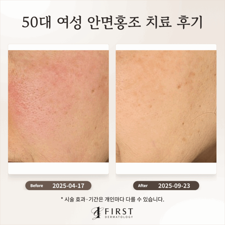 50대 여성 안면홍조 치료 후기(만성 홍조)