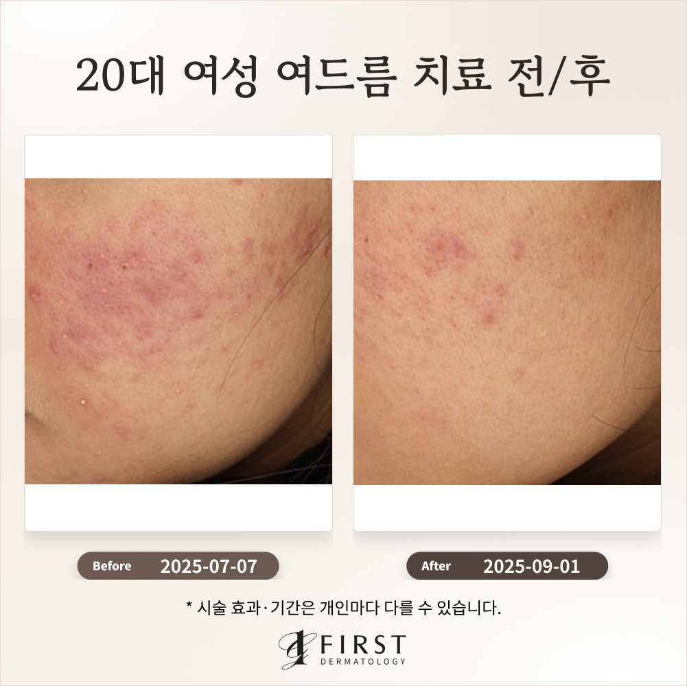 20대 여성 여드름 붉은 자국 치료 후기_수지여드름피부과