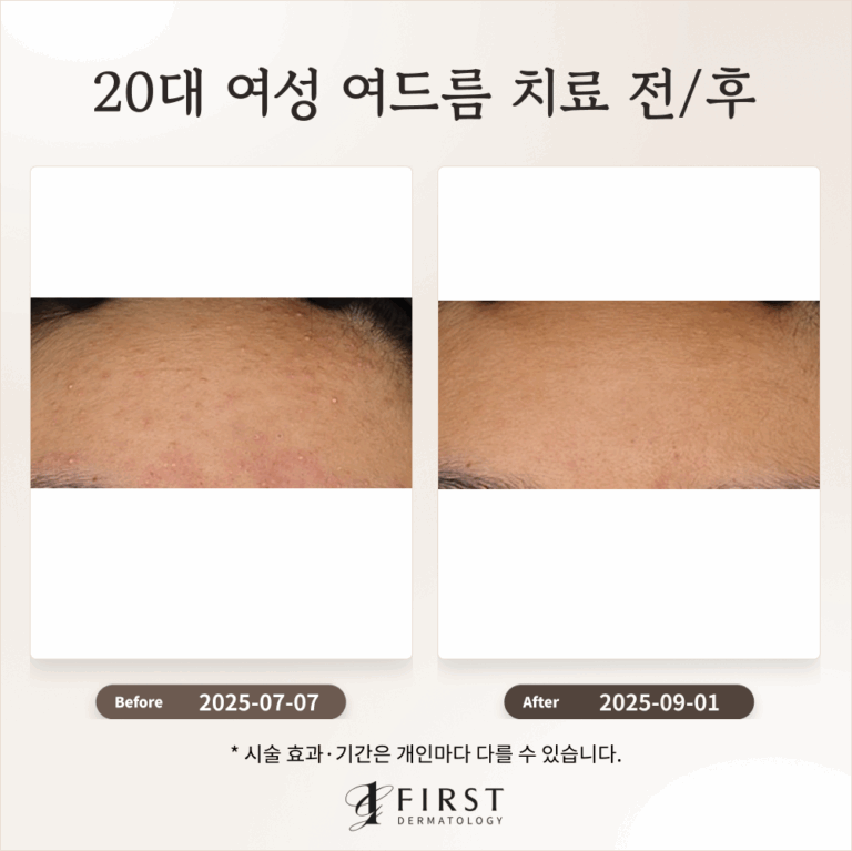 20대 여성 여드름 붉은 자국 치료 후기_수지여드름피부과