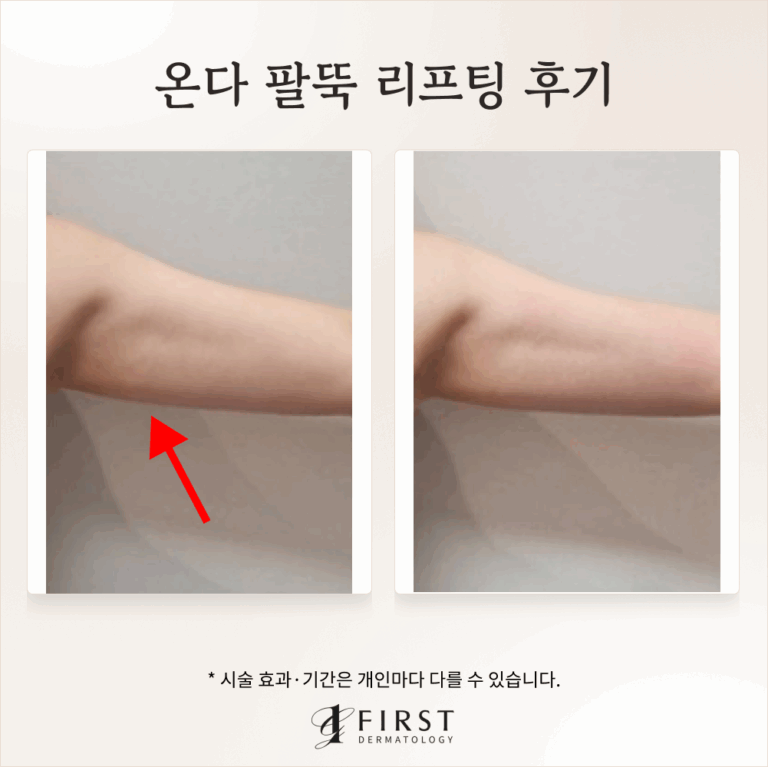 40대 온다 바디 리프팅 후기 #군살제거 가능할까?