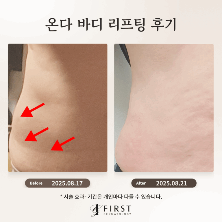 40대 여성 뱃살 군살 온다 리프팅 후기