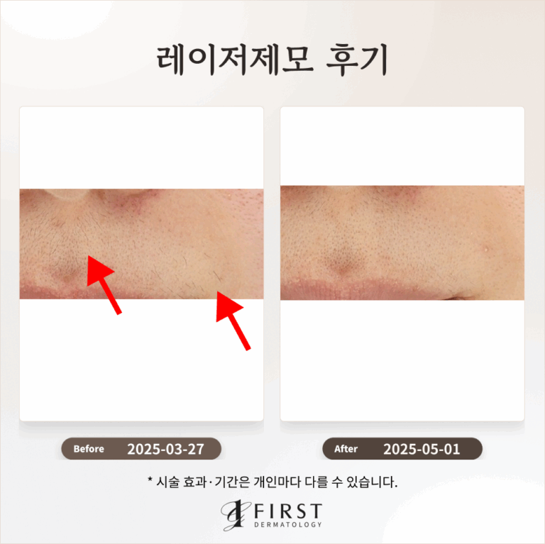 30대 여성 제모 1회 효과는