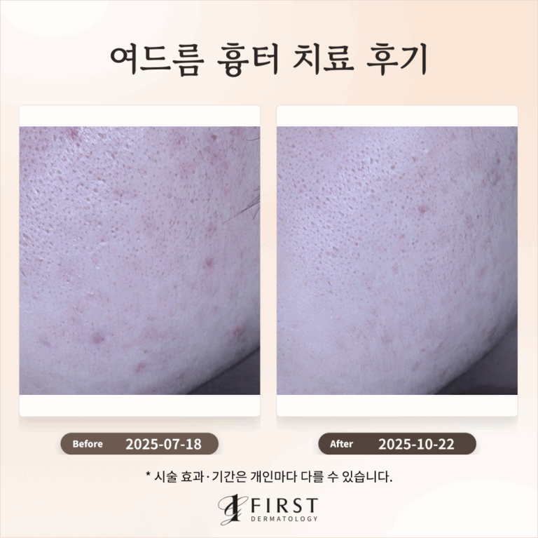 20대 여드름 흉터 치료 과정 소개 #효과적인 치료방법