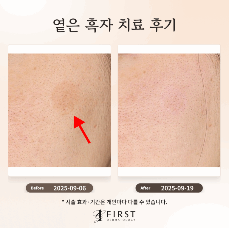 30대 여성 옅은 갈색 반점(흑자) 제거 후기 #흑자제거방법