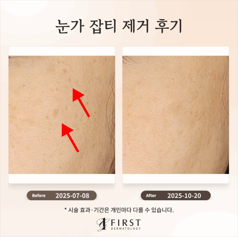 눈가 부위 잡티, 기미 개선 후기 #잡티제거방법