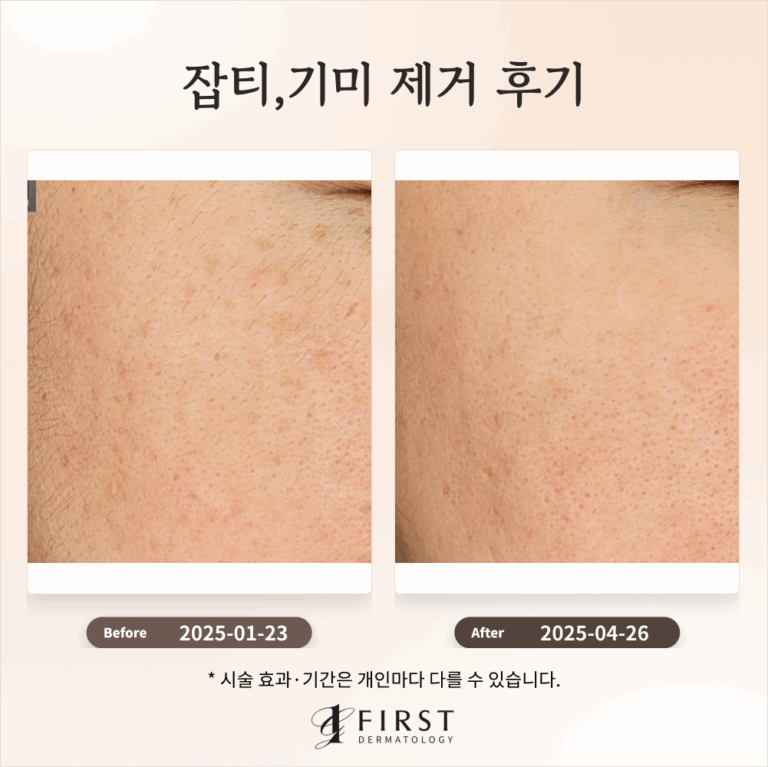 30대 여성 레이저 토닝으로 잡티 개선 후기 #잡티 제거 방법