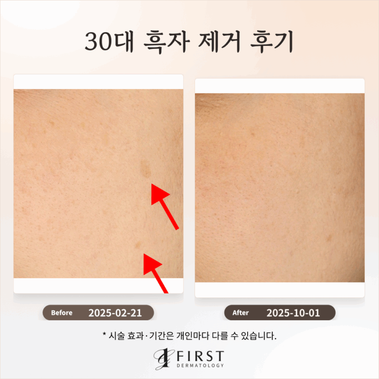 30대 옅은 갈색 반점(흑자) 제거 후기