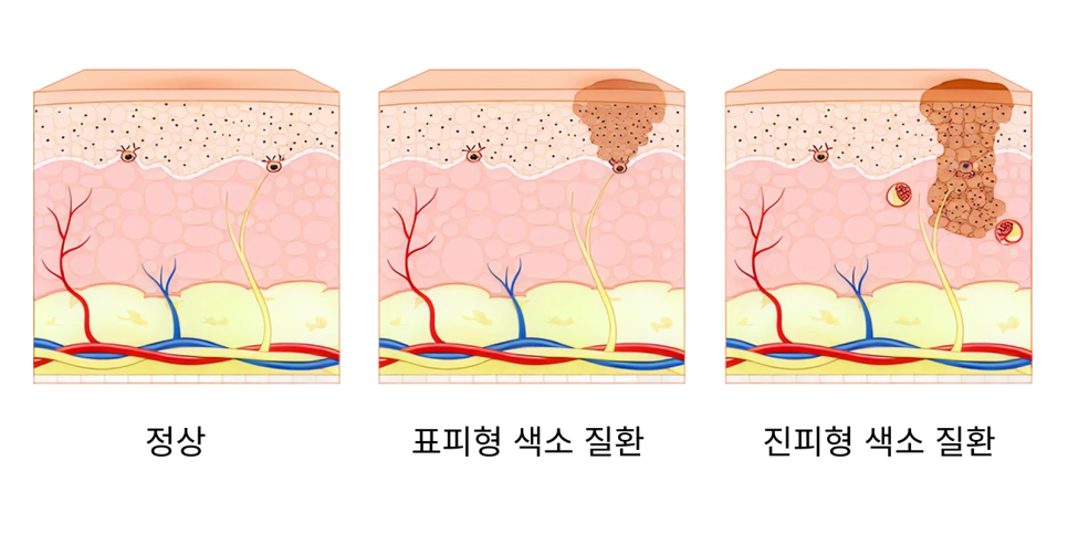 광교퍼스트_진피