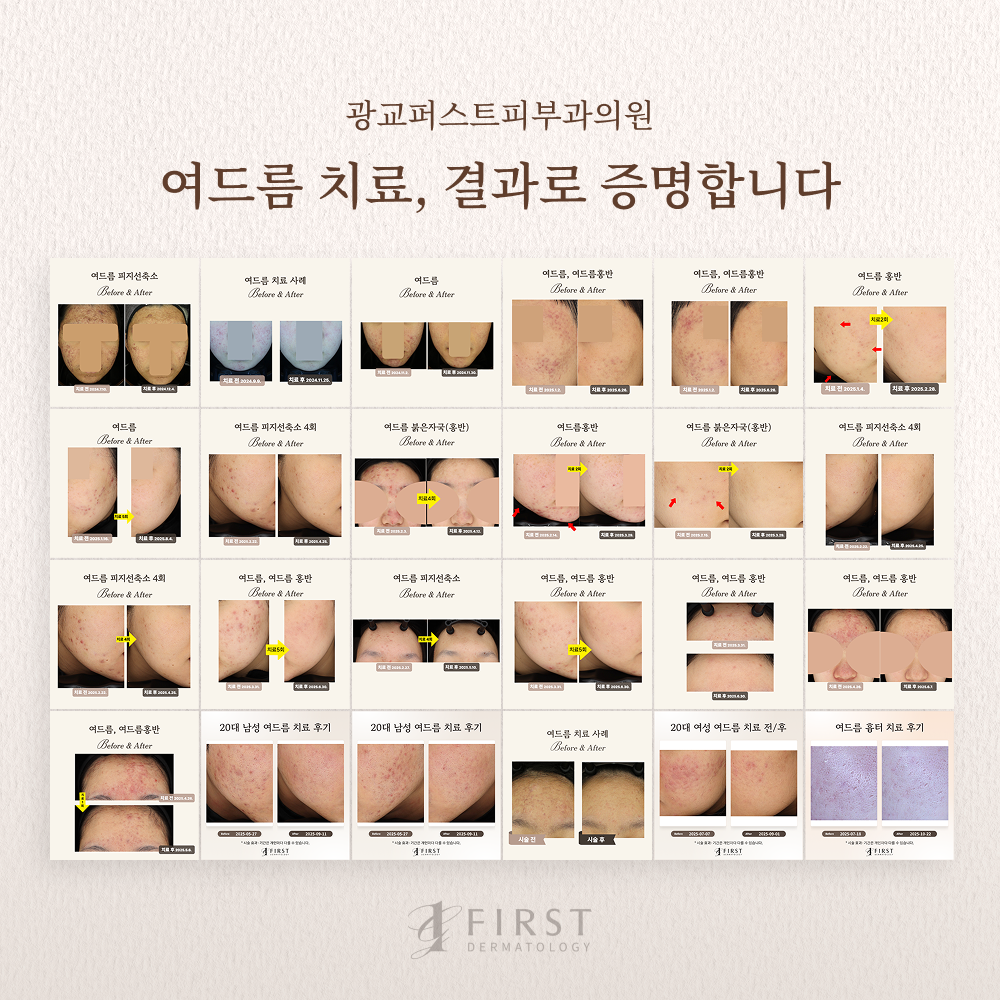 광교 퍼스트 피부과 여드름 치료 후기 안내 배너
