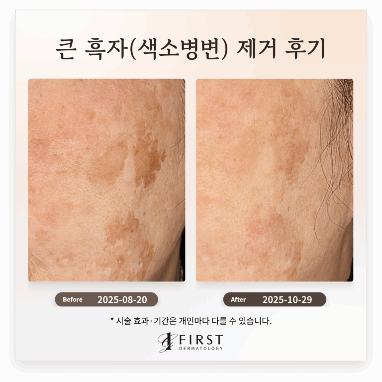 60대 여성 얼굴 곳곳에 위치한 큰 흑자(색소병변) 제거 후기_수원 색소 피부과