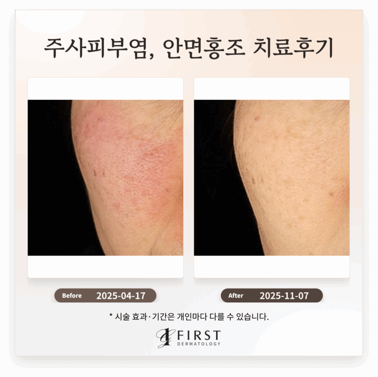 60대 주사피부염, 안면홍조 치료후기_피부과 전문의