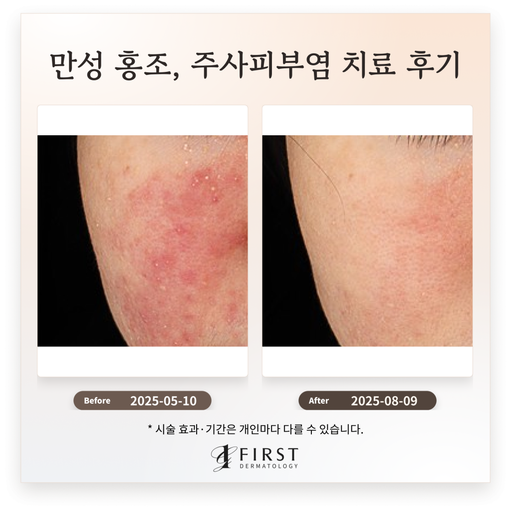만성 홍조, 주사피부염 치료 후기_브이빔 치료 효과