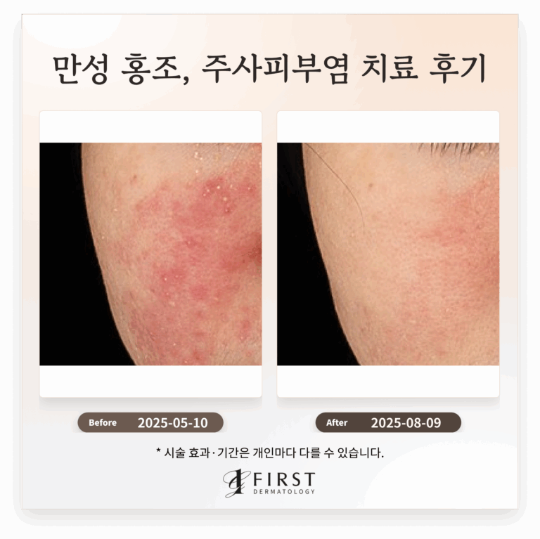 만성 홍조, 주사피부염 치료 후기_브이빔 치료 효과