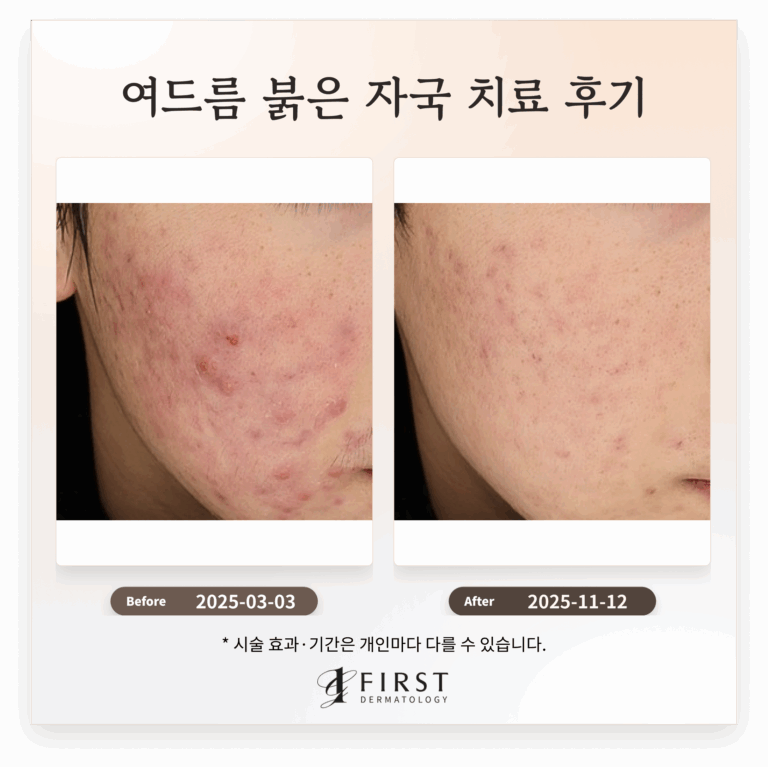 20대 남성 여드름, 여드름 붉은 자국 치료 후기_수원 피부과 전문의