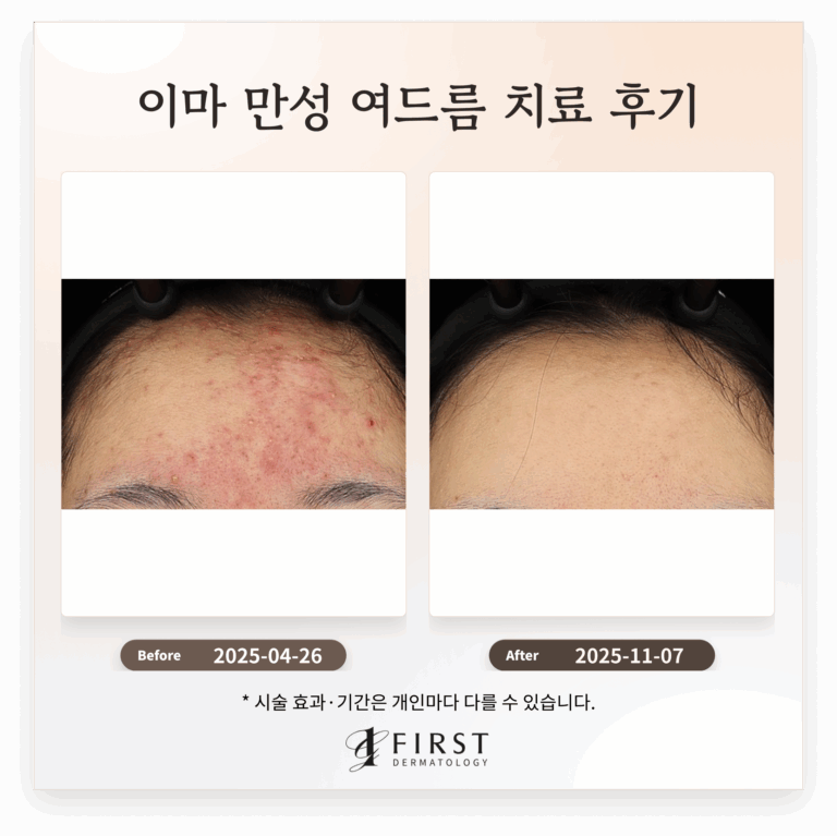 이마 만성 여드름 치료 후기_ 여드름 피부과 치료 방법 소개