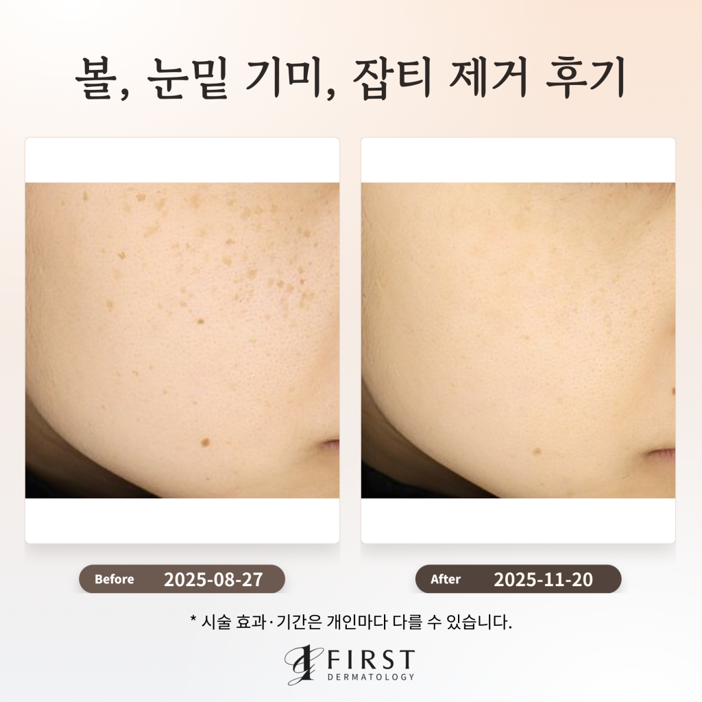 볼, 눈밑 기미, 잡티 제거 후기_수원 색소 피부과 전문의