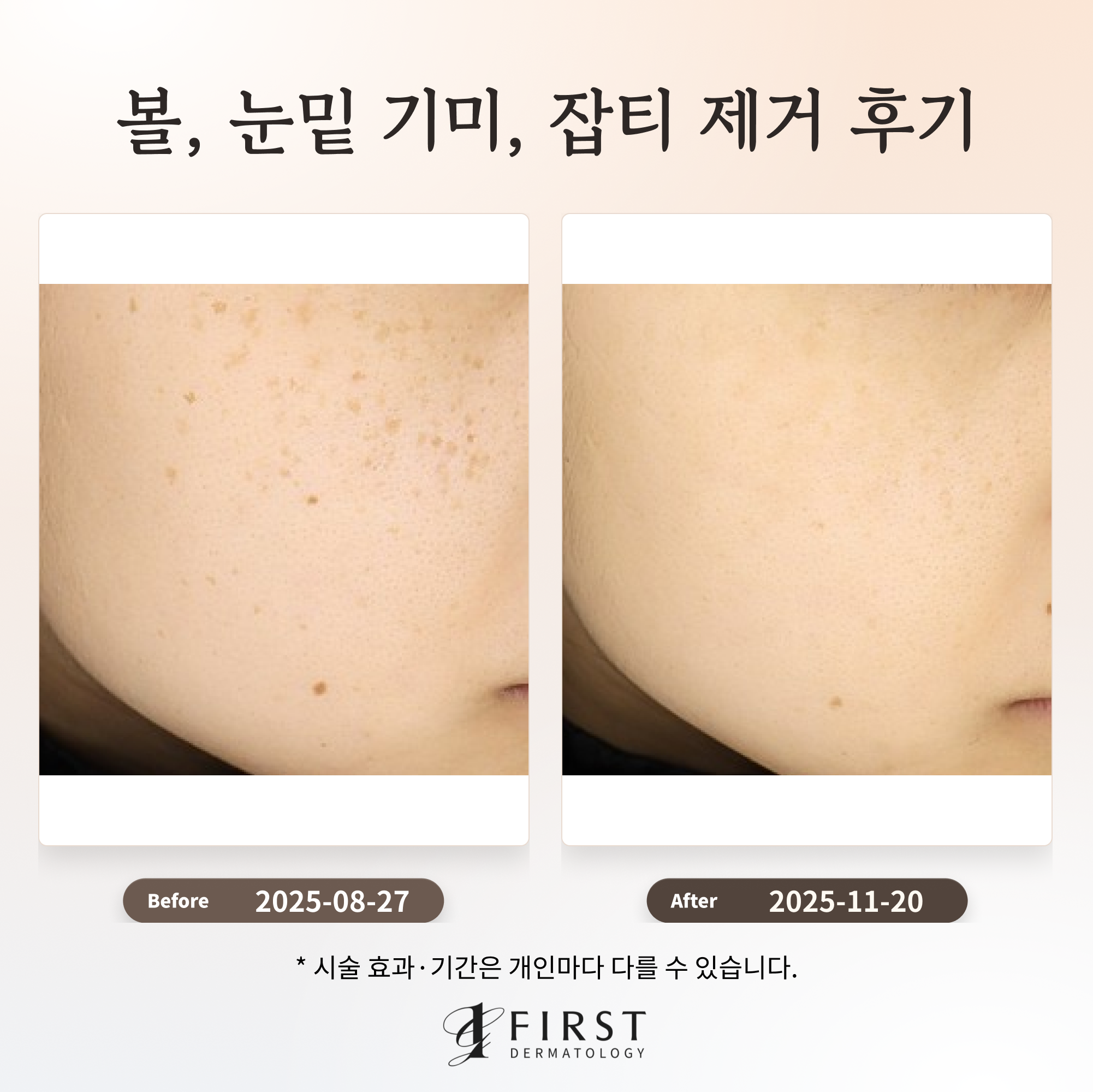 20대 볼·눈밑 기미와 잡티 얼굴한판·토닝 치료 전후