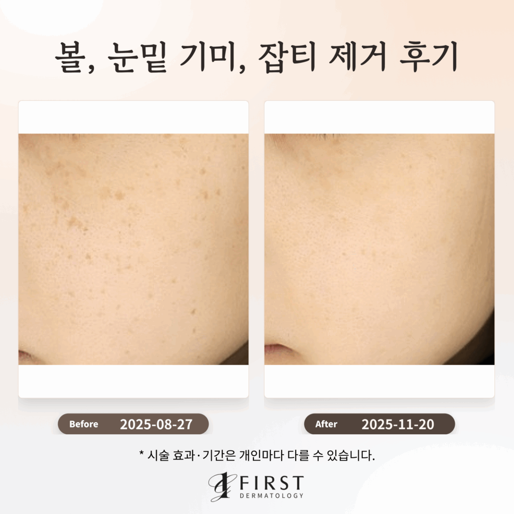 볼, 눈밑 기미, 잡티 제거 후기_수원 색소 피부과 전문의 | 광교 퍼스트 피부과ㅣ수원 영통, 광교 여의사 피부과 전문의