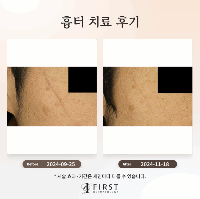 흉터 치료 방법 후기로 살펴보기_피부과 전문의