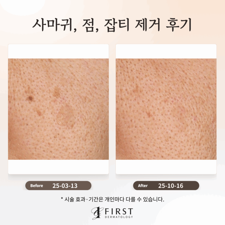 40대 남성 사마귀, 점, 잡티 제거 후기