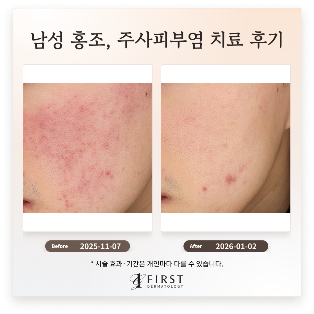 20대 남성 홍조, 주사피부염 치료 후기_ 효과적인 치료 방법 소개