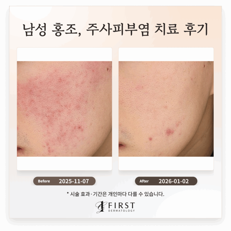 20대 남성 홍조, 주사피부염 치료 후기_ 효과적인 치료 방법 소개