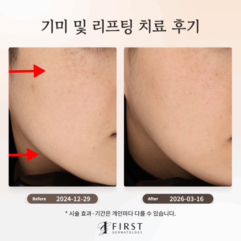 기미 및 리프팅 치료 후기