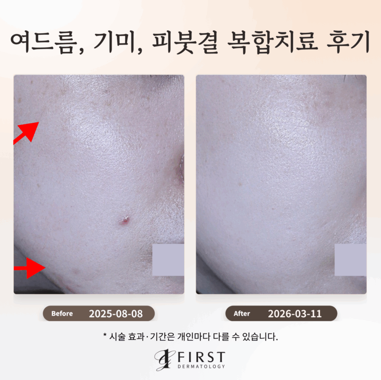 여드름, 기미, 피붓결 복합 치료 후기