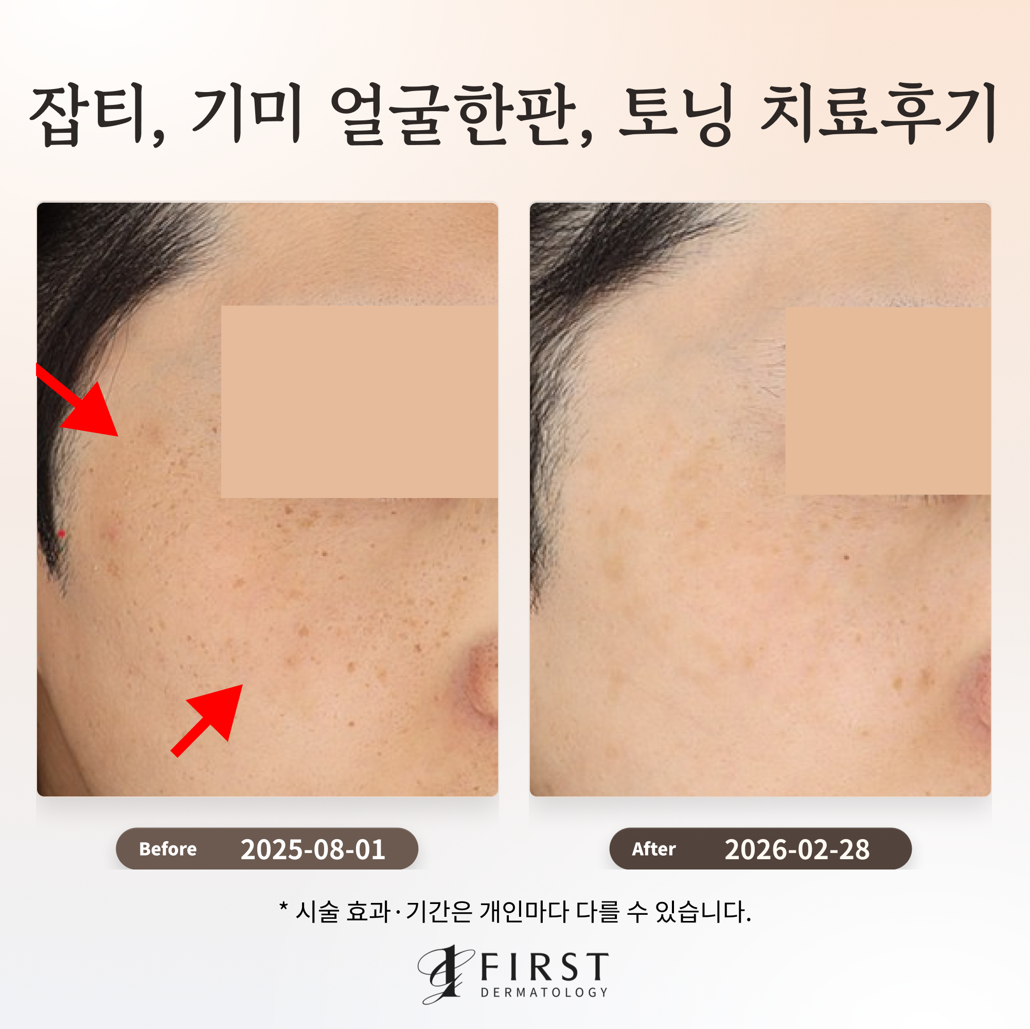 20대 남성 이마와 볼의 잡티·기미가 얼굴한판과 토닝 후 옅어진 전후