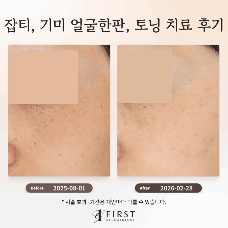 잡티 및 기미 얼굴한판, 토닝 치료 후기