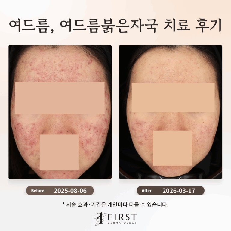 여드름, 여드름붉은자국 치료 후기