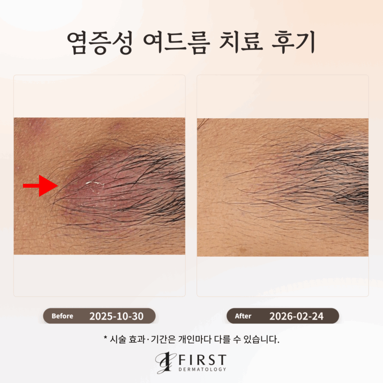 염증성 여드름 치료 후기