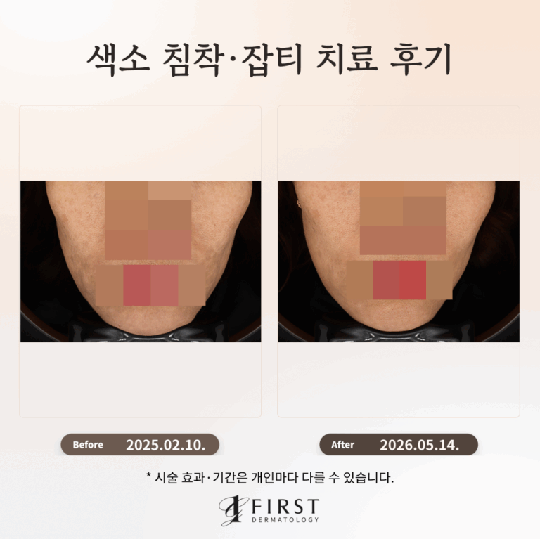 잘못된 피부관리로 생긴 색소질환 치료 후기