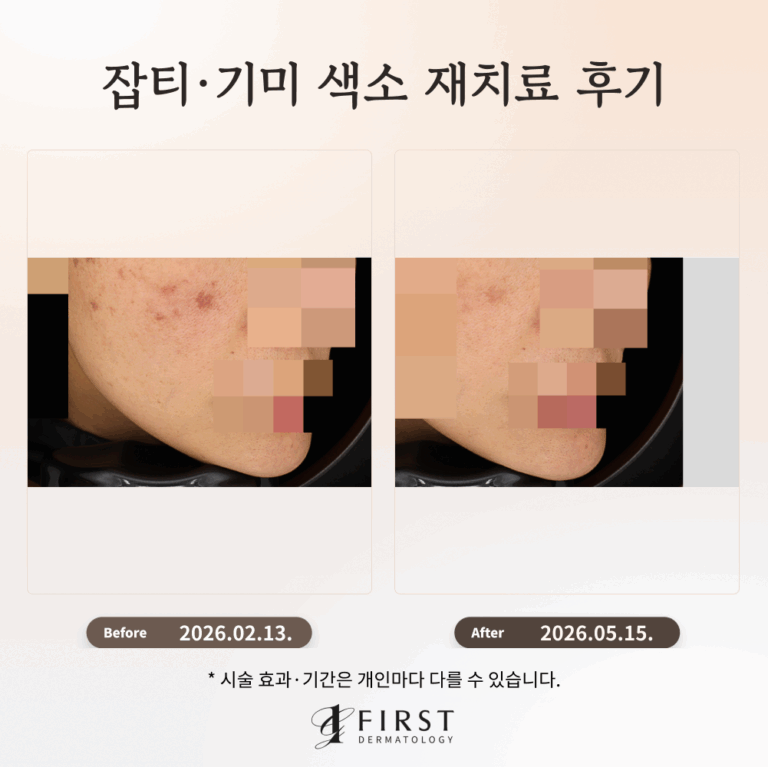 잘못된 색소 치료, 색소침착 부작용 치료 후기