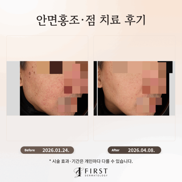 50대 남성 안면홍조·점 치료 후기